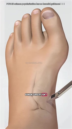 Lapiplasty Procedure 3D Animation #bunions #bunioncorrector #footsurgery #bunionectomyrecovery#3dmedicalanimation