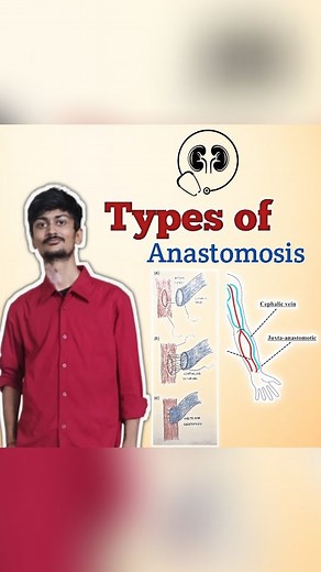Expert Dialysis on Instagram: "📸✨ Understanding Fistula Anastomosis Types ✨📸Fistula anastomosis is a crucial surgical procedure to ensure proper blood flow in patients requiring dialysis. Here are the main types: 🔸 End-to-Side Anastomosis: This involves connecting the end of a vein to the side of an artery. It's commonly used due to its ease of creation and good patency rates. 🔸 Side-to-Side Anastomosis: In this type, the side of a vein is connected to the side of an artery. It's less common