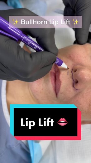 Tag a friend that needs to see this! ✨👄 A Bullhorn Lip Lift shortens the space between the base of the nose and the upper lip, making the lips appear fuller and more pronounced. 👉The surgeon makes incisions under the nostrils, in the shape of a bull’s horn. 👉The scars are carefully placed within the skin’s natural folds and creases to be discrete. 👉Skin is removed just below the margin between the nose and the lip. 👉This exposes more of the red part of the lip and makes the shape of the mou