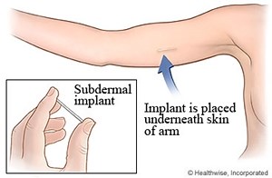 What are the 10 kinds of Birth Control Methods?