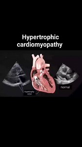 Hypertrophic Cardiomyopathy (HCM) is a genetic condition characterized by the thickening of the heart muscle, particularly the interventricular septum. This thickening can obstruct blood flow from the left ventricle to the aorta, a condition known as Left Ventricular Outflow Tract (LVOT) Obstruction. When this obstruction occurs, it is referred to as Hypertrophic Obstructive Cardiomyopathy (HOCM). Key Features of HOCM: Septal Hypertrophy: The thickening of the septum can impede blood flow, leadi