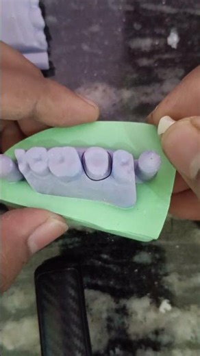 3D scanner model #CAD CAM model #Zirconia Crown