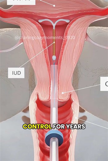 How IUDs Work? | Intrauterine Device (3D Animation) #intrauterinedevice #intrauterinedevices #iud #iudinsertion #copperiud #hormonaliud #iudinsertion #birthcontrol #birthcontroloptions #medical3danimation #3dmedicalanimation