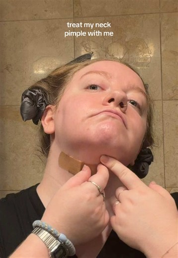 Neck Pimple Treatment: Step-by-Step Fix with PRID & Pimple Patch