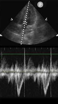 LVOT VTI to measure Cardiac Output #ultrasound #POCUS #emergencymedicine #criticalcare
