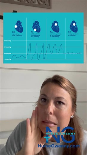 More on pulmonary artery catheters! In this video I review swan ganz waveforms and what to do when it’s not where it should be. Like the way I teach? Check out my books and clinical field guides at NurseGwenny (dot) com Intended for educational purposes only. Always follow your local protocols. #ERNurse #EmergencyNurse #CEN #CFRN #CTRN #ICUNurse #NCLEX #NursingSchool #NursingStudent #Nurse #ICUNurse #CCRN #FlightNurse #FlightMedic #FPC #paramedic #criticalcare #HEMS | NurseGwenny