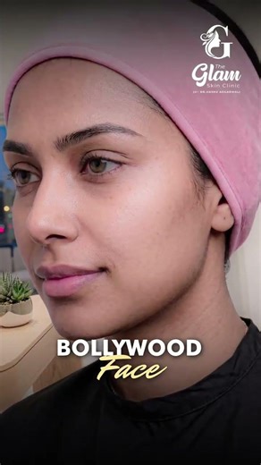 The Ultimate "Bollywood Face" Transformation | Dermal Fillers Step-by-Step ✨