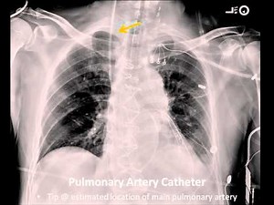 ICU Chest Radiography