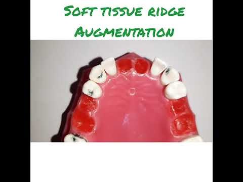 Residual ridge defects and Management in Fixed Prosthodontics