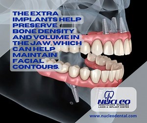 All-on-6 prosthetic teeth are designed to look natural and complement the patient's features. Contact us for more information. . Phone: 915 308 0101 nucleodental.com . #NucleoDental #dentalclinicnearme #oralhealth #dentaltourismmexico #dentalimplantsjuarez #bestdentalserviceintown #dentalservice #juarez #cdjuarez #elpasotexas | Nucleo Dental | Facebook