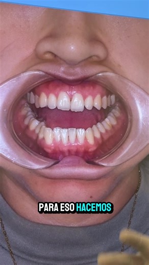 Tratamiento de Mordida Cruzada con MARPE: Caso Real