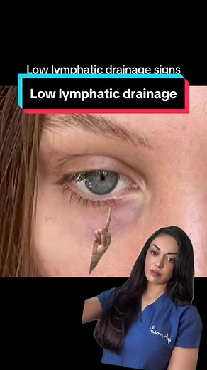 Symptoms of low lymphatic drainage include swelling (edema), skin discoloration, rashes, recurrent infections, slow wound healing, fatigue, varicose veins, lipodermatosclerosis, lymphorrhea, and possible exacerbation of acne and allergies. #lymphaticdrainage #lymphedema #immunesystem #immunity #edema #undereyebags #health #lymphaticsystem #skincare #varicoseveins #cellulitis #foryou #foryoupage #foryourpage #fyp