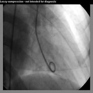 Takotsubo cardiomyopathy 008Vb04