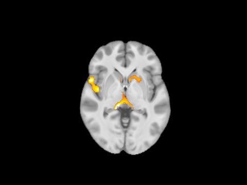 Early Imaging Detection of ALS and FTD