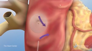 Approximately 2,000 babies are born each year with Atrial Septal Defect (ASD), a condition where a child has an abnormally large hole between the chambers of the heart after birth. Find out how this condition is repaired. #NCHHeart #HeartMonth | Nationwide Children's Hospital