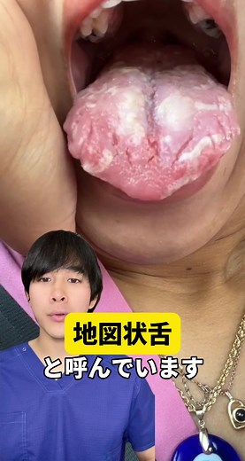 地図状舌の症状と治療について