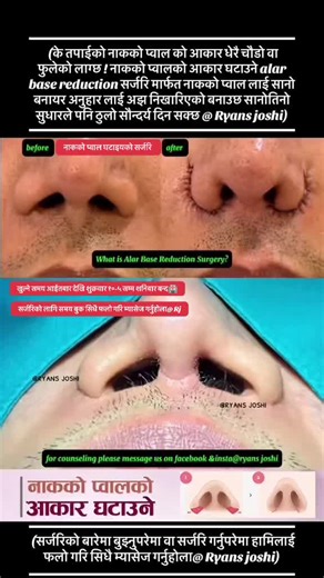 Alar Base Surgery for Improved Facial Harmony