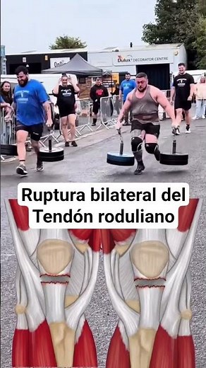 Ruptura bilateral del tendón rotuliano