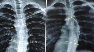 SCOLIOSIS - PAANO ALAMIN KUNG MAYROON KAYO O ANG MGA ANAK NINYO 😊 Hello, everyone! Ito na po ang ipinangako kong simpleng video kung paano alamin kung posibleng may scoliosis kayo o ang inyong mga anak. 😊 Ang scoliosis ay kondisyon kung saan tabingi o naka-kurba ang “spine” o “backbone” o gulugod sa halip na diretso. Kadalasan ay nagsisimulang tumabingi ang backbone habang tumutubo ito sa ating kabataan or teenage years. Maaari din itong makita na laganap sa isang pamilya, o pwede din na in-bo