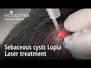Sebaceous cysts Lupia - Laser treatment - 24098
