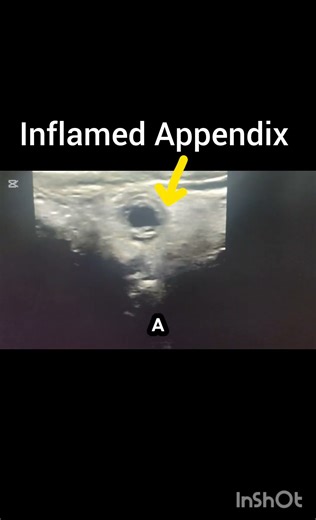 Ultrasound showing appendicitis! Findings of appendix ultrasound!#ultrasoundmadeeasy86#radiology#uk