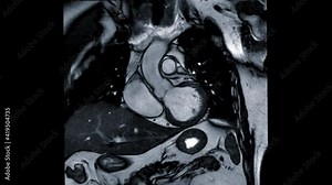 MRI heart or Cardiac MRI ( magnetic resonance imaging ) of heart in coronal view showing heart beating for detecting heart disease.