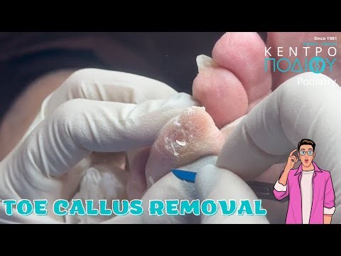 Toe Callus RemovalΑφαίρεση κάλου #kentropodiou #κεντροποδιου #podologos #podiatrist #podiatry #feet