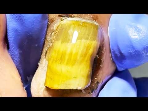 Rectangular Onychomycosis Nails, Cut Off The Fungus Step By Step! 【Dr. Liu's Pedicur】
