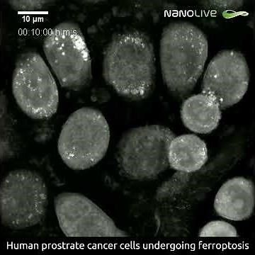 Nanolive technology reveals ferroptosis execution in an aggressive human prostate cancer model