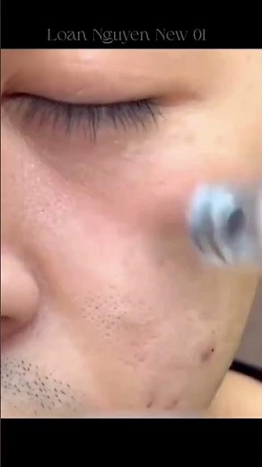 Amazing Electric Blackhead Vacuum Device | Blackhead Remover Suction Tool for Clear Skin #blackheads