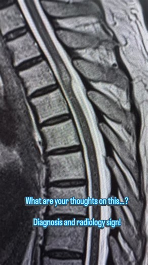 Radiology Verse on Instagram: "A 63 year old male presenting with complains of back pain, upper and lower limbs weakness along with sensory symptoms and hyperreflexia. Can you diagnose it with the classic radiology sign…? Answer will be provided after sometime. “Radiology that teaches. Cases that stay with you.” If you found this reel helpful, don’t forget to LIKE, SHARE & SUBSCRIBE for more rare radiology cases, MRI findings, and academic discussions. #radiology #radiologist #mri #radiologyeduc