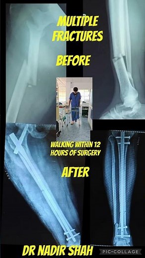 COMPLEX FRACTURES#IT WITH SHAFT FEMUR#TIBIA FRACTURE#BEST ORTHOPAEDIC#DR NADIR SHAH