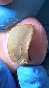 Doctors were stunned by what came out of this nail EGVP Beautiful moments of care and relaxation through a gentle pedicure experience. Simple, clean, and satisfying. 🌿✨ Disclaimer: This video is for educational and relaxation purposes only. All content belongs to the respective owners, no copyright infringement is intended. | T Nap