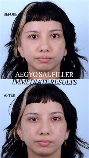 DrKennethKim on Instagram: "Aegyo Sal Filler — Subtle Under-Eye Enhancement ✨ My patient shares her experience with aegyo sal filler, followed by her before-and-after results. Aegyo sal refers to the small fat pads just beneath the lower lash line. This feature is especially popular in Korean aesthetics and is known for creating a soft, youthful appearance—giving the eyes a gentle, smiling expression. To achieve this look, filler must be placed with precision. When done correctly, even a small a