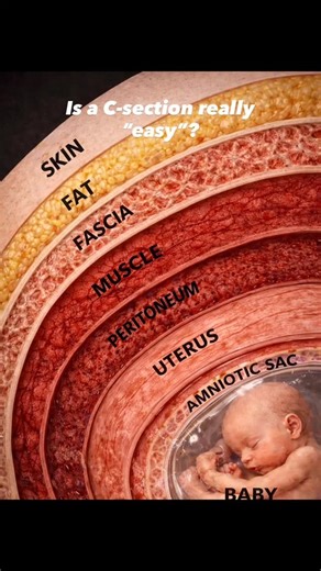 Parents Finds on Instagram: "Is a C-section really “easy”? Many people think it’s just one cut. But doctors carefully go through multiple layers to safely deliver a baby. Skin → Fat → Fascia → Muscle → Peritoneum → Uterus → Amniotic sac → Baby This is not weakness. This is strength. This is surgery. Understanding this helps with: • Respect for mothers • Better recovery expectations • Informed birth decisions • Medical awareness 👉 Save this for future reference 👉 Tag someone who still thinks C-