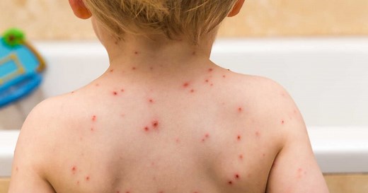 Comment différencier la rougeole de la varicelle ?