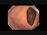 Endoscopic Examination of Cecum With Straight Scope - 360 Degree Rotation • Video • MEDtube.net