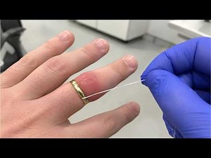 How to Remove a Stuck Ring From a Swollen Finger