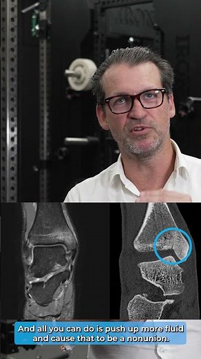 Medial malleolar stress fractures
