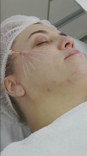 TÉCNICA DE APLICAÇÃO DA INTRADERMOTERAPIA | ‪@professorheitorcruz‬