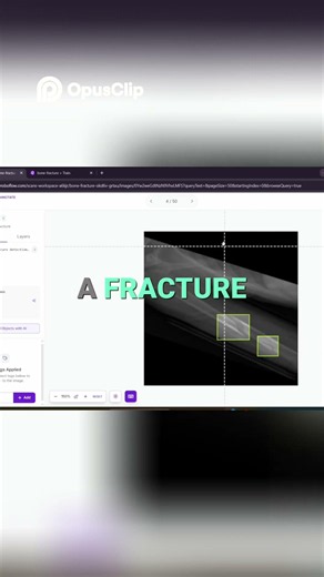 How AI Learns to Detect Fractures 🦴 #shorts