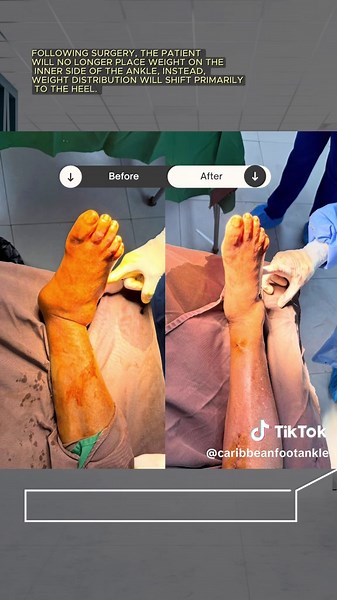COFAI (@caribbeanfootankle) - Diabetic Charcot’s Foot Surgery Explained