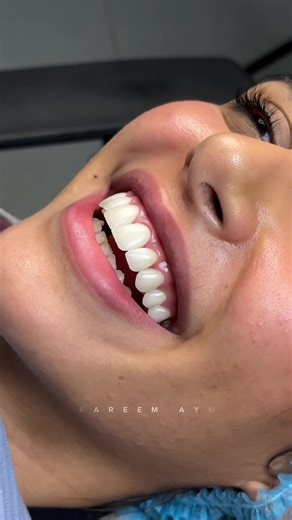 Lot of work, lot of passion achieving a world-class porcelain veneers! Margot Robbie Smile? Go get it !🔥 #Smilemakeover •For appointments & consultation : •DrKareem.reservations@outlook.com •WhatsApp : 201067699950 Cairo,Egypt 📍 _______________ #viralvideos #aesthetic #fypviralシ #dentist #veneers #hollywood #cairo #egypt #SmileMakeover #porcelainveneers #KSA #dubai🇦🇪 #riyadh🇸🇦 #قشور_خزفية_هوليوود_سمايل_تجميل_اسنان🦷 #naturalveneers #viral_video