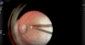 A Case of Optic Pit Maculopathy - Eyetube