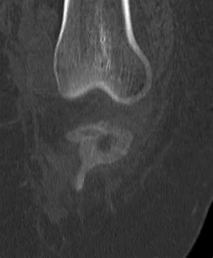 Orthopaedic Trauma on Instagram: "Another badly depressed lateral tibial plateau fracture. You can imagine how unstable this knee is with valgus stress. I see so many of these and they have become one of my favourites to fix! This looks scary given how bad the depression is. But these are rather straightforward to fix: ⭐️ Open the lateral wall ⭐️ Look inside at the depressed articular fragment ⭐️ Meniscus is usually driven in the defect & must be extracted ⭐️ Use an osteotome to mobilize the dep