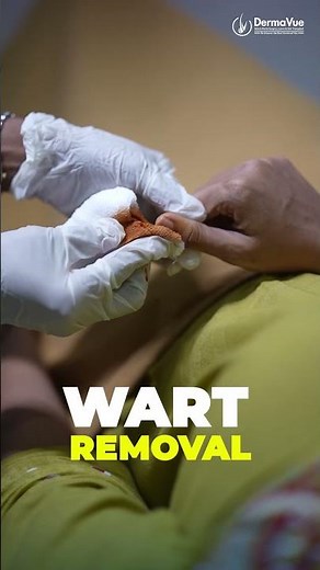 Bleomycin Injection for Recalcitrant Warts: Wart Removal Treatment that's Viral Now ‪@DermaVue‬