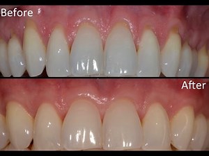 Upper and Lower Teeth Gum Recession Treated with Alloderm & Emdogain.