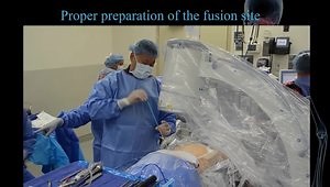 Can We and How Do We Really Do a Good Endoscopic Fusion?