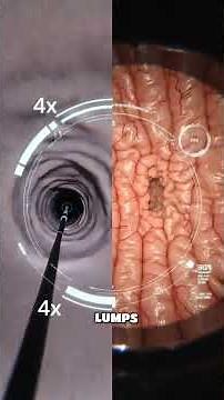 What is a Colonoscopy? The Complete Procedure Explained
