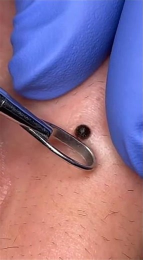 “Thick Wax-Like Blackhead Core Removal | 4K Macro” #skincare #asmr